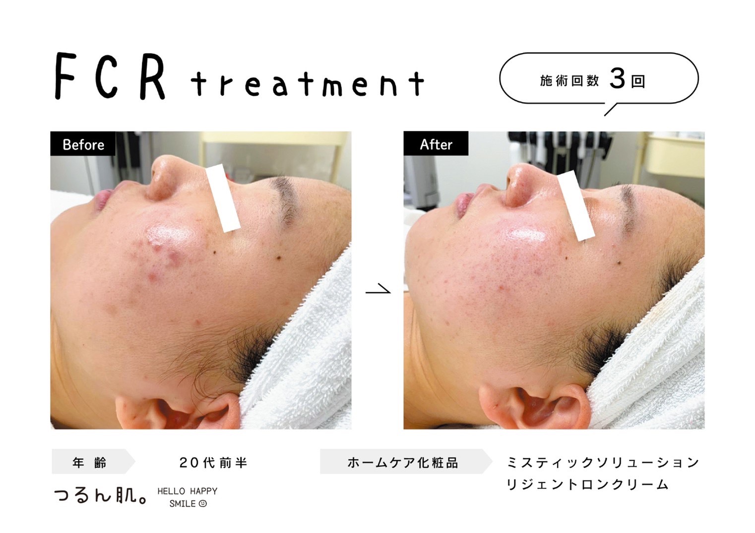 FCRとエニシーグローパックで肌トラブル改善！！ | 福岡の博多、天神のエステサロン『美肌と脱毛 つるん肌。』(脱毛・フェイシャル)